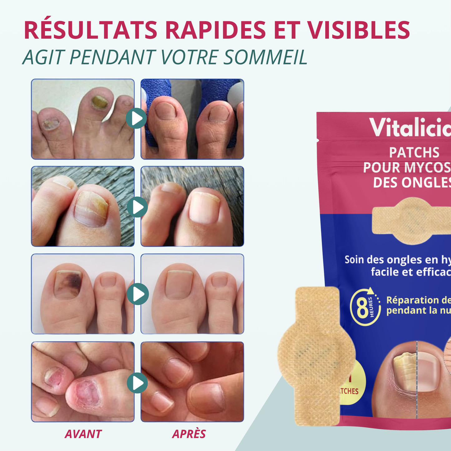 Patchs + Sérum Réparation Mycoses Ongles