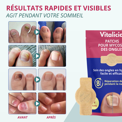 Patchs + Sérum Réparation Mycoses Ongles